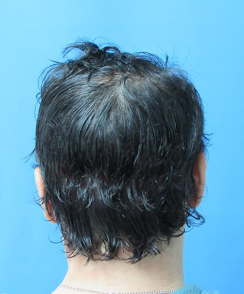 hair restoration patient