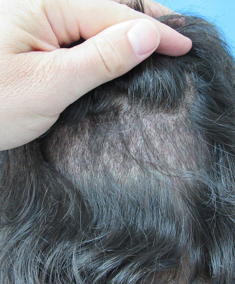 hair restoration patient