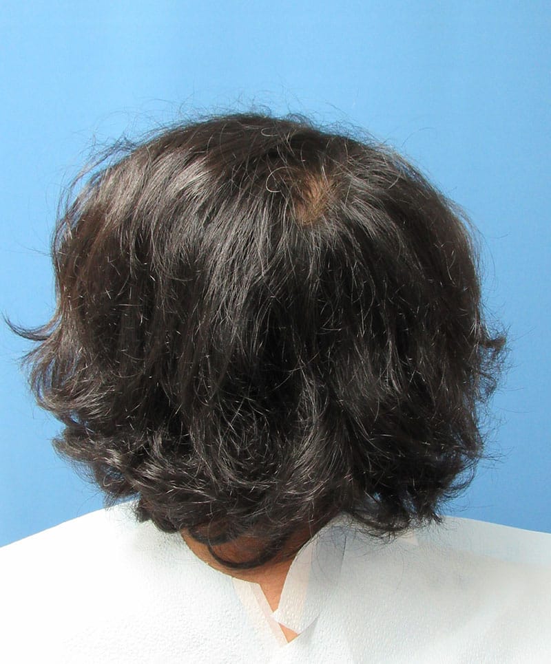 hair restoration patient
