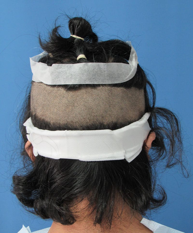 hair restoration patient