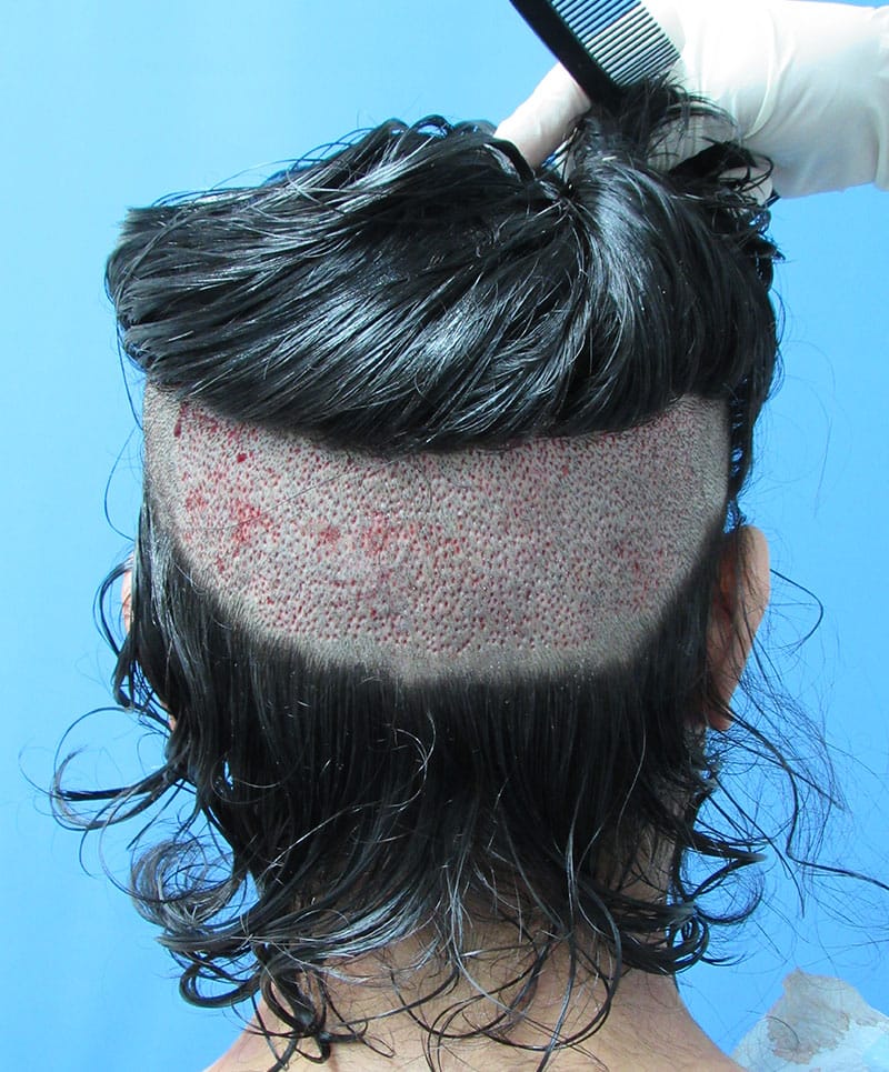 hair restoration patient