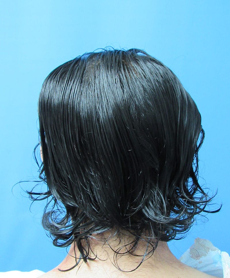 hair restoration patient