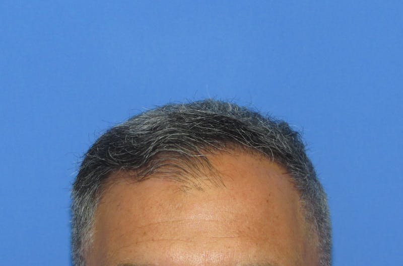 Male Hair Transplant Before & After Gallery - Patient 276794 - Image 2