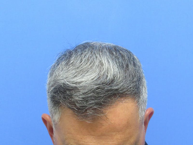 Male Hair Transplant Before & After Gallery - Patient 276794 - Image 4