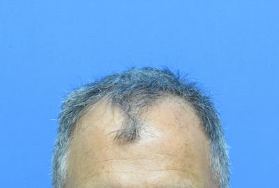Male Hair Transplant Before & After Gallery - Patient 276794 - Image 1