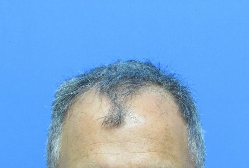 Male Hair Transplant Before & After Gallery - Patient 276794 - Image 1