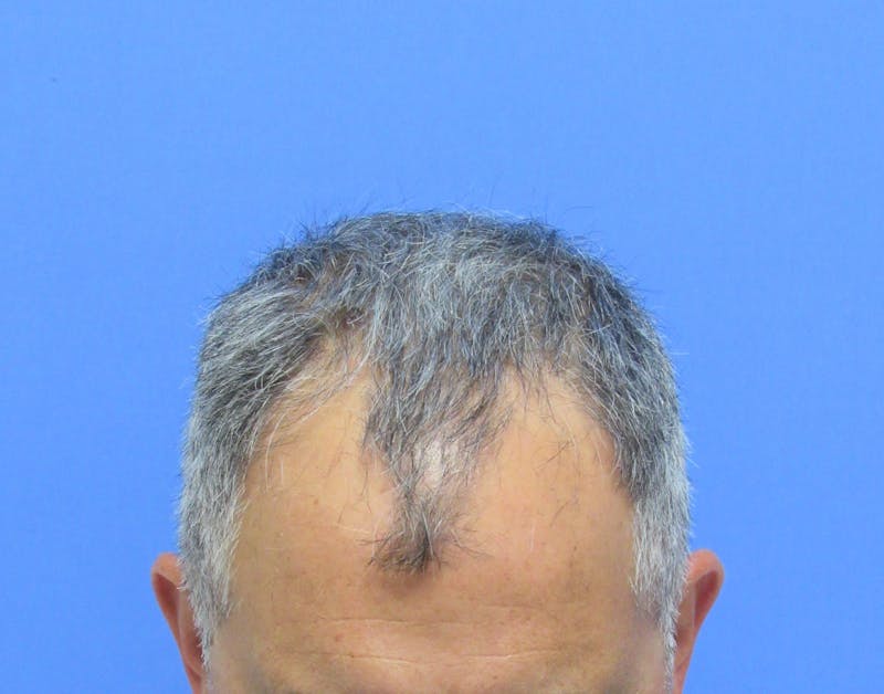 Male Hair Transplant Before & After Gallery - Patient 276794 - Image 3