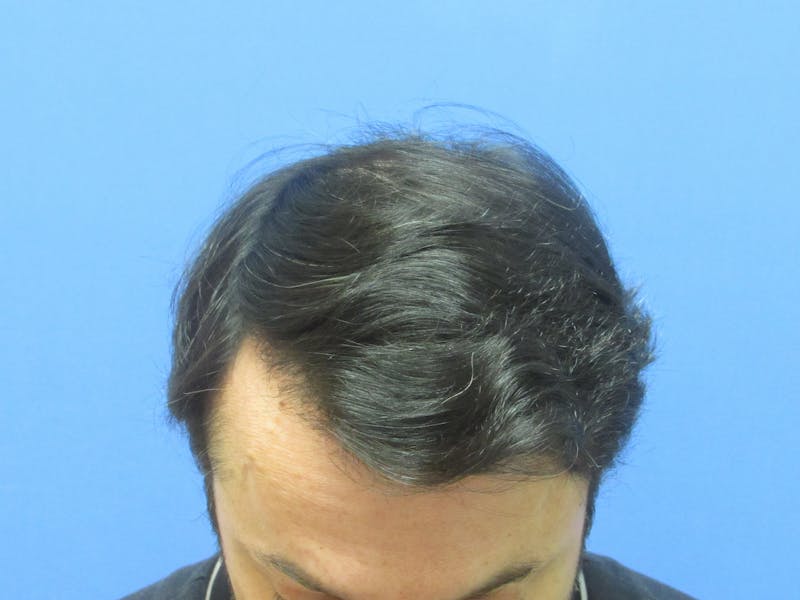 Male Hair Transplant Before & After Gallery - Patient 120436 - Image 4