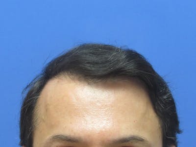 Male Hair Transplant Before & After Gallery - Patient 120436 - Image 2