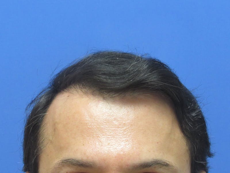 Male Hair Transplant Before & After Gallery - Patient 120436 - Image 2