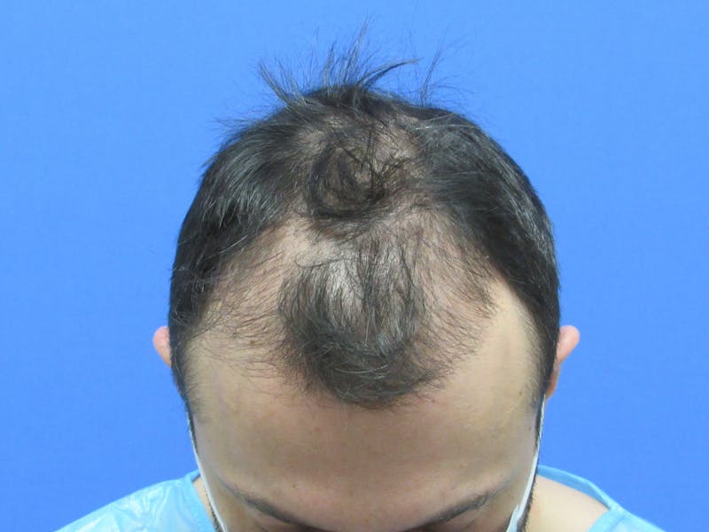 Male Hair Transplant Before & After Gallery - Patient 120436 - Image 3