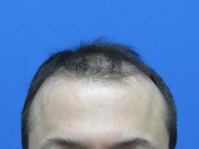 Male Hair Transplant Before & After Gallery - Patient 120436 - Image 1