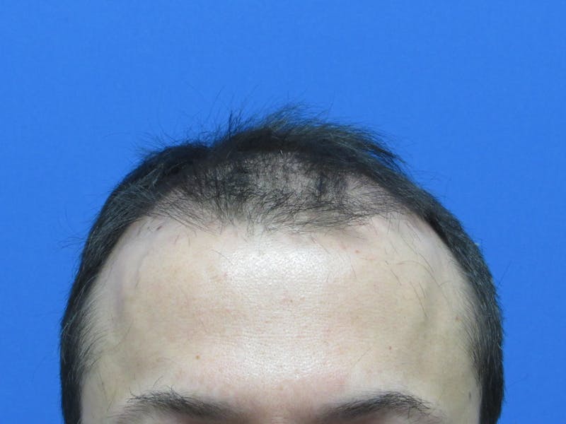 Male Hair Transplant Before & After Gallery - Patient 120436 - Image 1