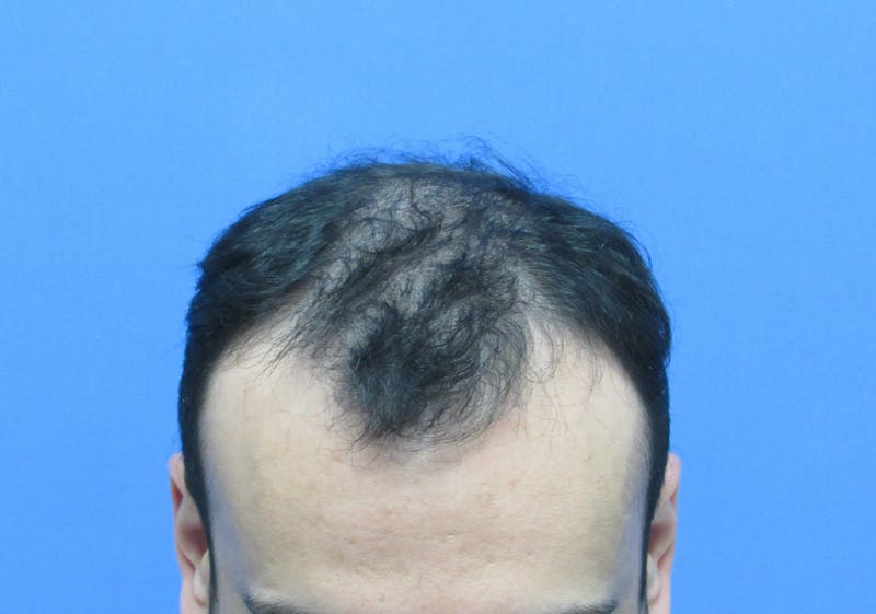 Male Hair Transplant Before & After Gallery - Patient 286789 - Image 3