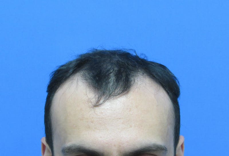 Male Hair Transplant Before & After Gallery - Patient 286789 - Image 1