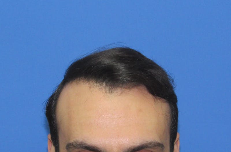 Male Hair Transplant Before & After Gallery - Patient 286789 - Image 2