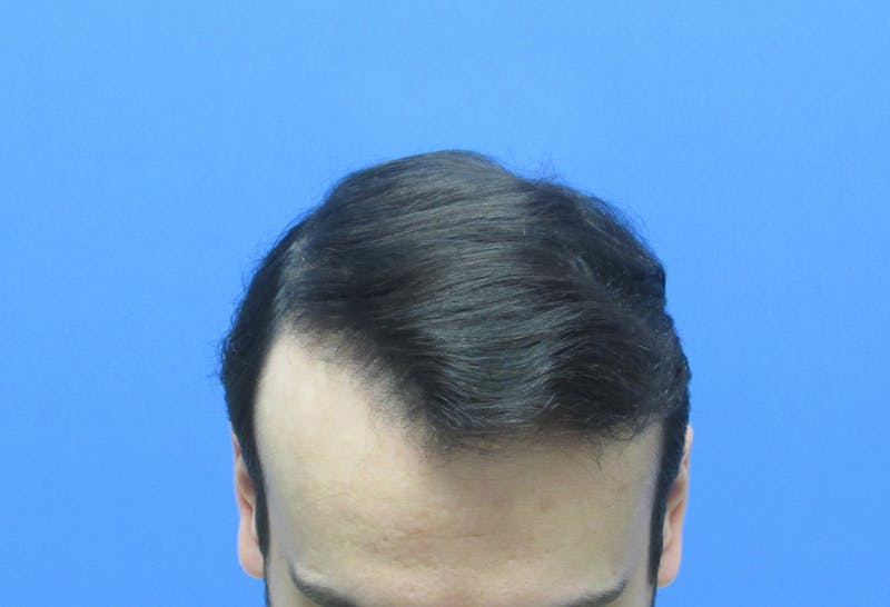 Male Hair Transplant Before & After Gallery - Patient 286789 - Image 4