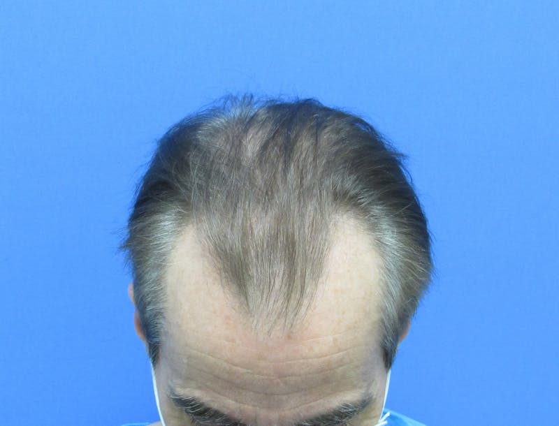 Male Hair Transplant Before & After Gallery - Patient 419057 - Image 3