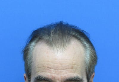 Male Hair Transplant Before & After Gallery - Patient 419057 - Image 1