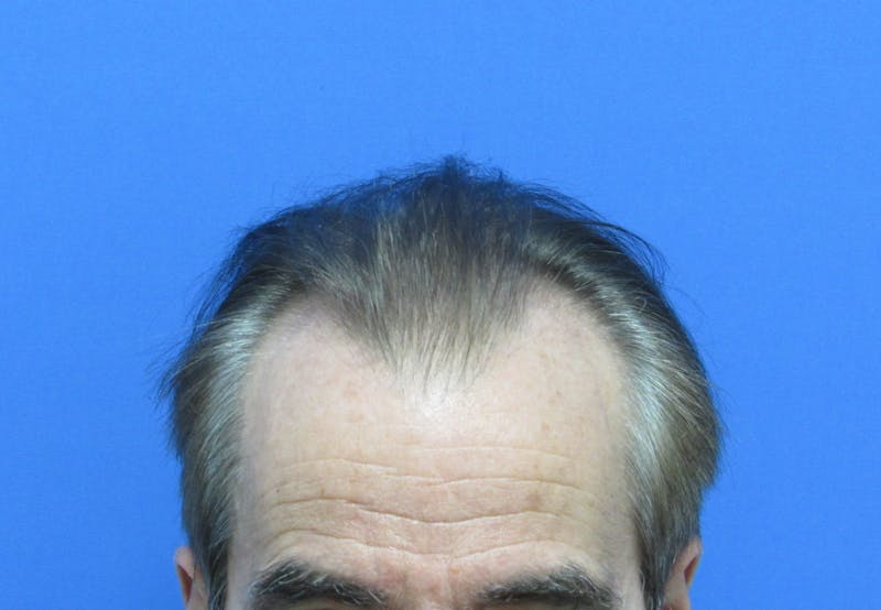 Male Hair Transplant Before & After Gallery - Patient 419057 - Image 1