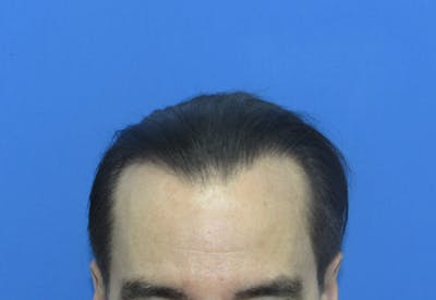 Male Hair Transplant Before & After Gallery - Patient 419057 - Image 2