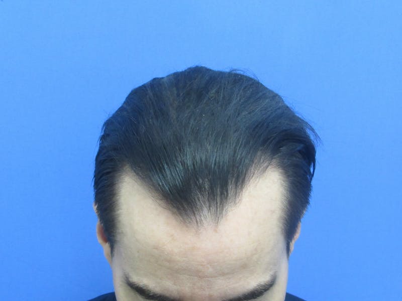 Male Hair Transplant Before & After Gallery - Patient 419057 - Image 4