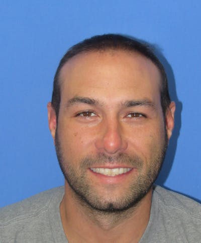 Male Hair Transplant Before & After Gallery - Patient 336319 - Image 2