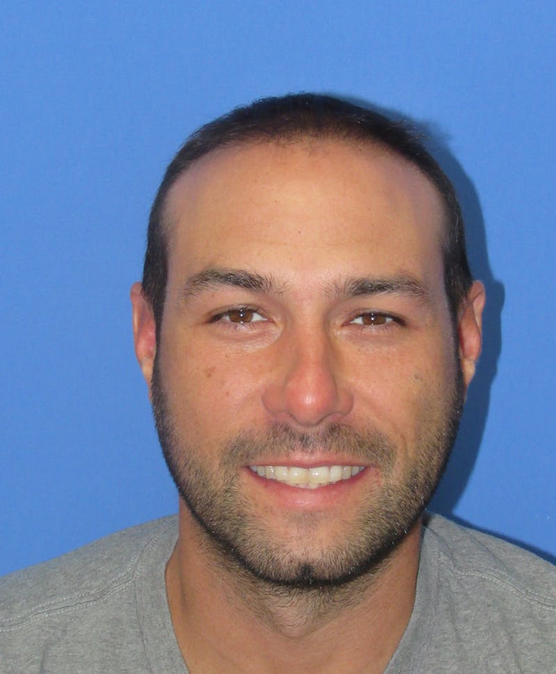 Male Hair Transplant Before & After Gallery - Patient 336319 - Image 4