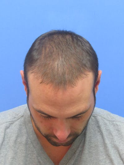 Male Hair Transplant Before & After Gallery - Patient 336319 - Image 2