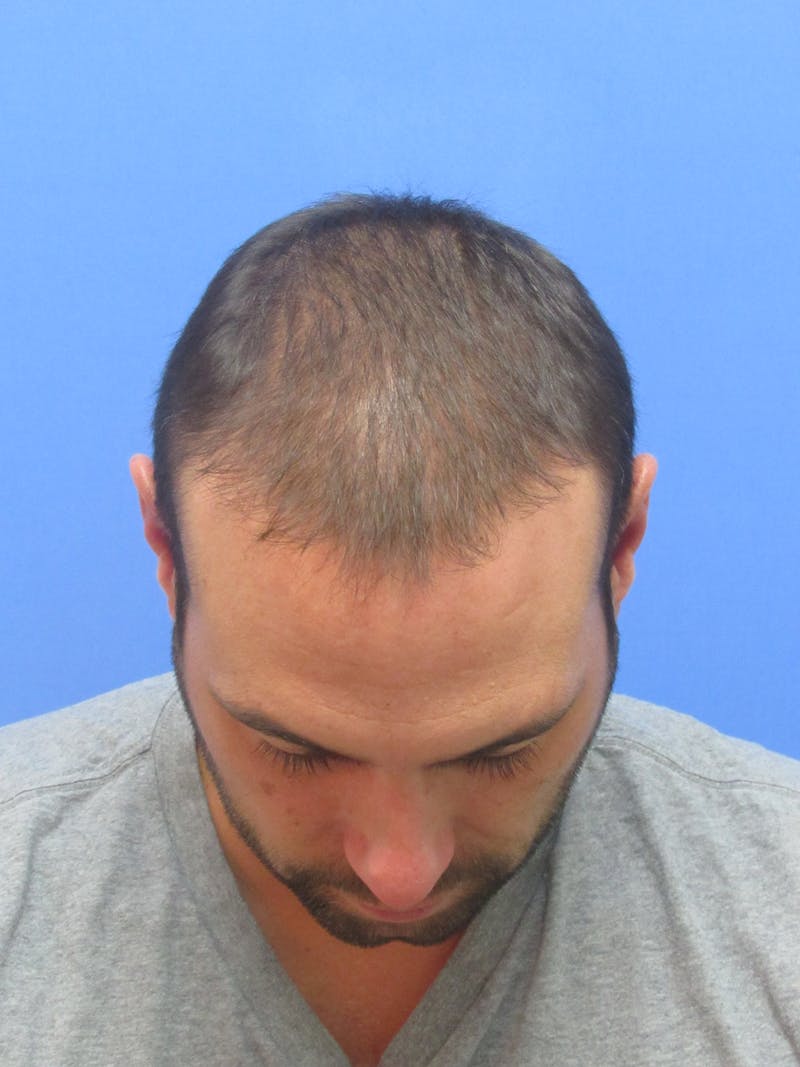 Male Hair Transplant Before & After Gallery - Patient 336319 - Image 2