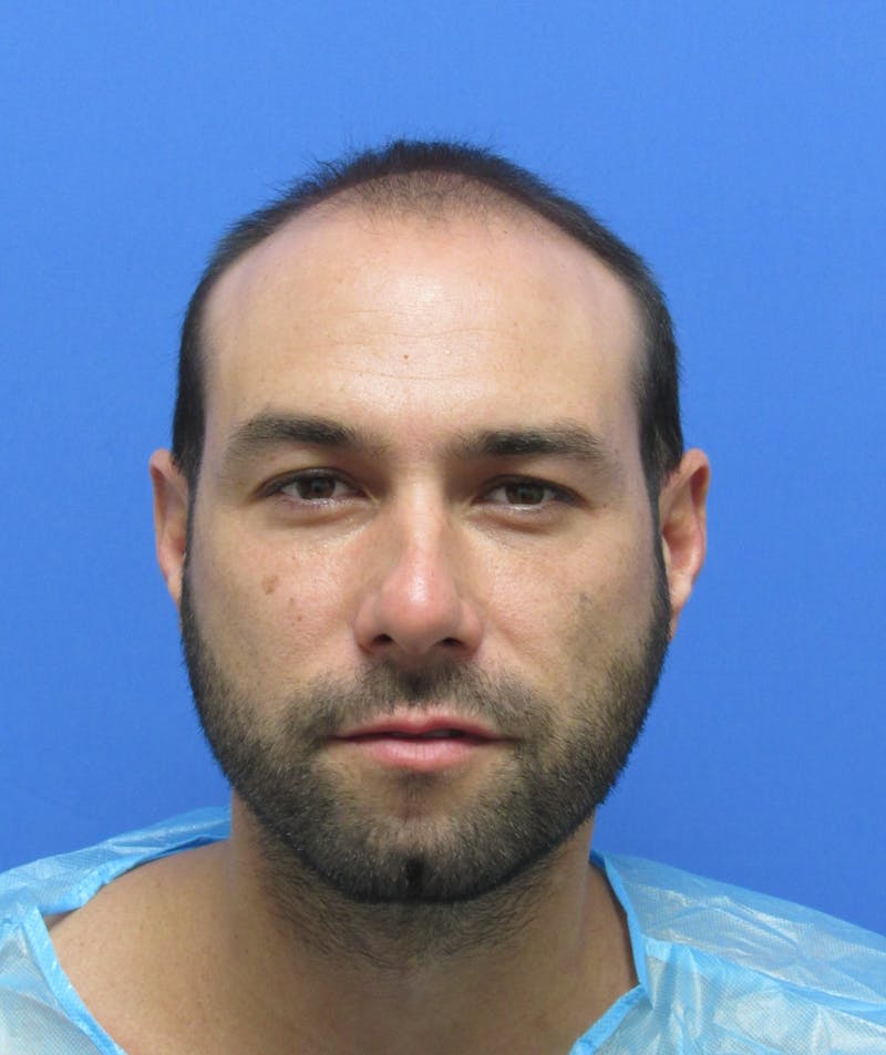 Male Hair Transplant Before & After Gallery - Patient 336319 - Image 3