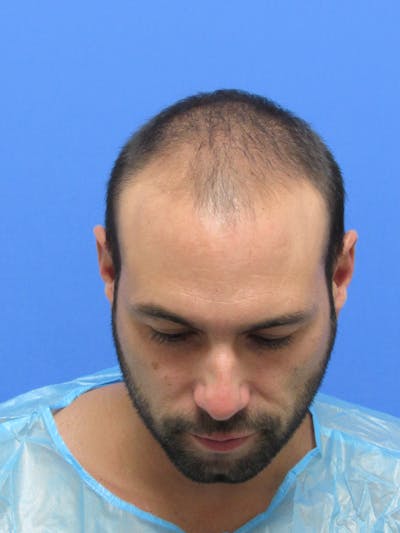 Male Hair Transplant Before & After Gallery - Patient 336319 - Image 1