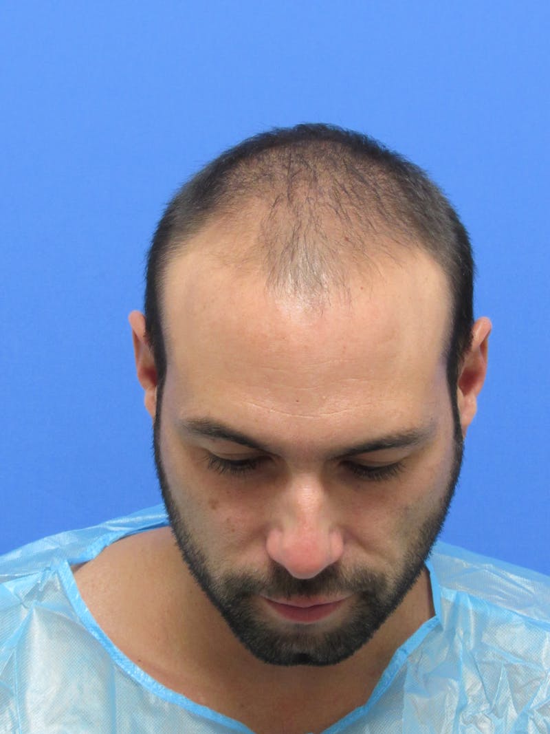 Male Hair Transplant Before & After Gallery - Patient 336319 - Image 1