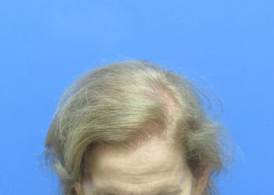 Female Hair Transplant Before & After Gallery - Patient 384550 - Image 2
