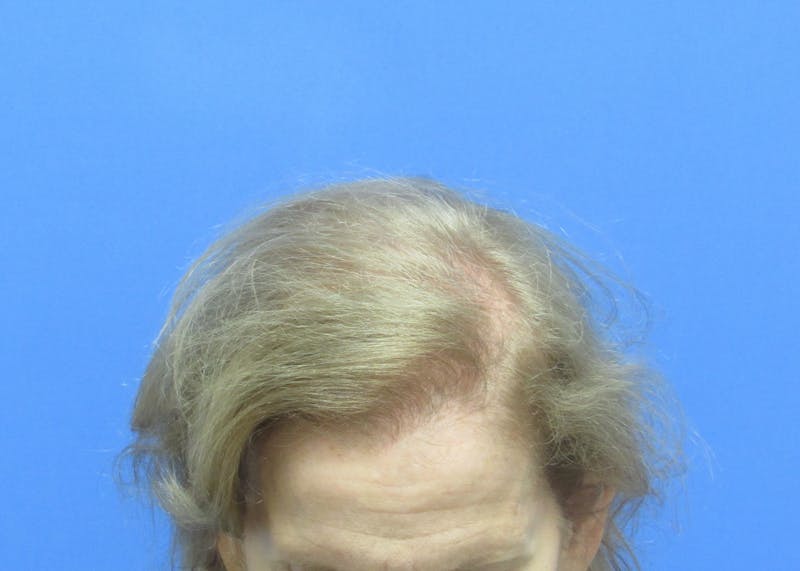 Female Hair Transplant Before & After Gallery - Patient 384550 - Image 2