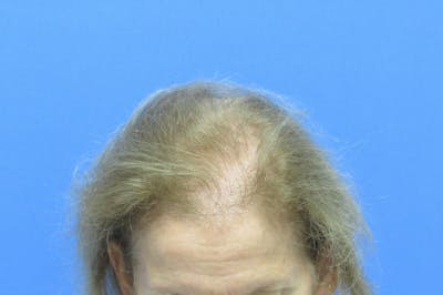 Female Hair Transplant Before & After Gallery - Patient 384550 - Image 1