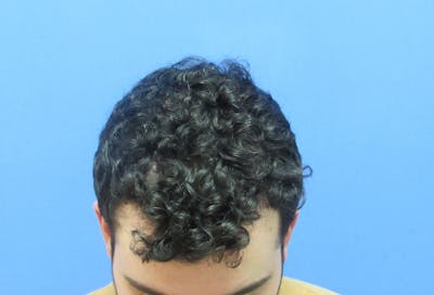 Male Hair Transplant Before & After Gallery - Patient 382396 - Image 2