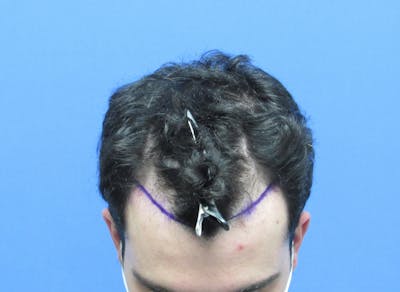 Male Hair Transplant Before & After Gallery - Patient 382396 - Image 1