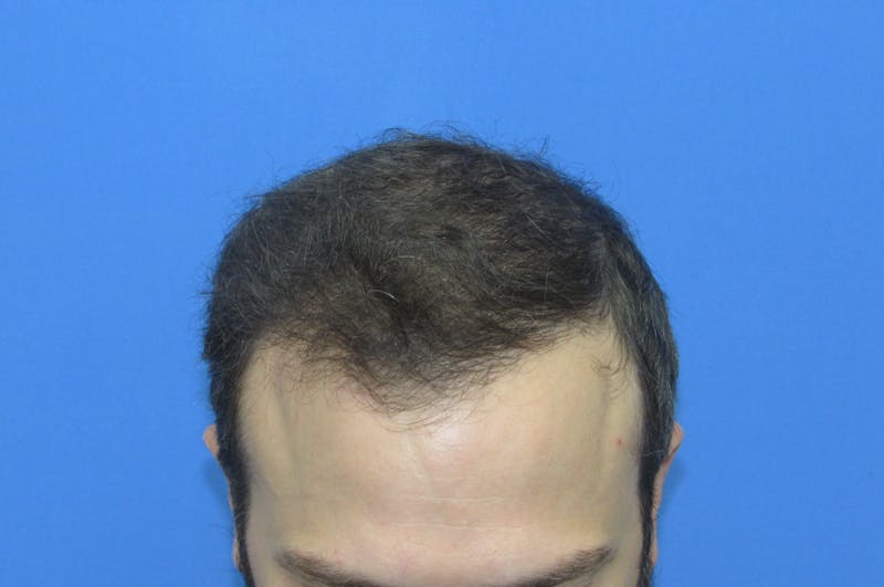 Male Hair Transplant Before & After Gallery - Patient 411931 - Image 4