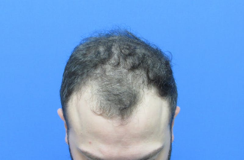 Male Hair Transplant Before & After Gallery - Patient 411931 - Image 3
