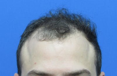 Male Hair Transplant Before & After Gallery - Patient 411931 - Image 1