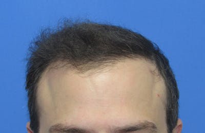 Male Hair Transplant Before & After Gallery - Patient 411931 - Image 2