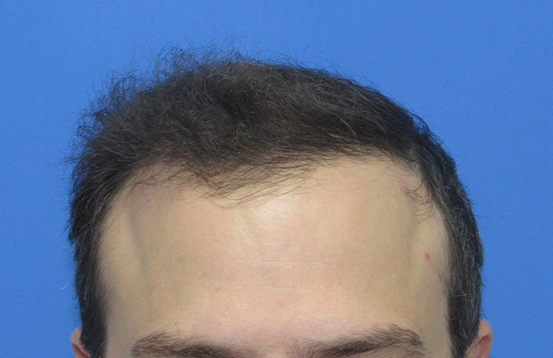 Male Hair Transplant Before & After Gallery - Patient 411931 - Image 2