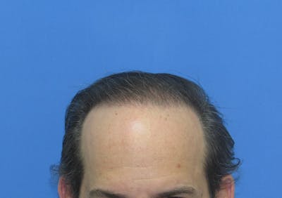 Male Hair Transplant Before & After Gallery - Patient 418481 - Image 2