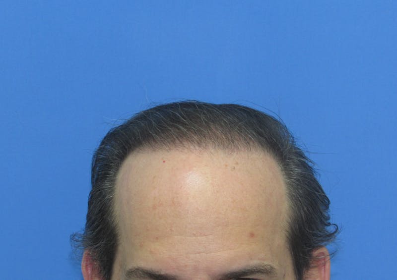 Male Hair Transplant Before & After Gallery - Patient 418481 - Image 2