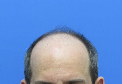 Male Hair Transplant Before & After Gallery - Patient 418481 - Image 1