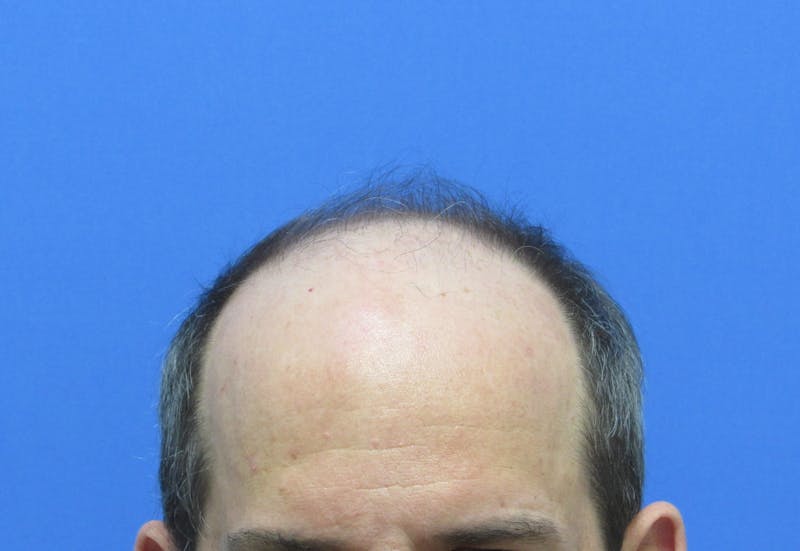 Male Hair Transplant Before & After Gallery - Patient 418481 - Image 1