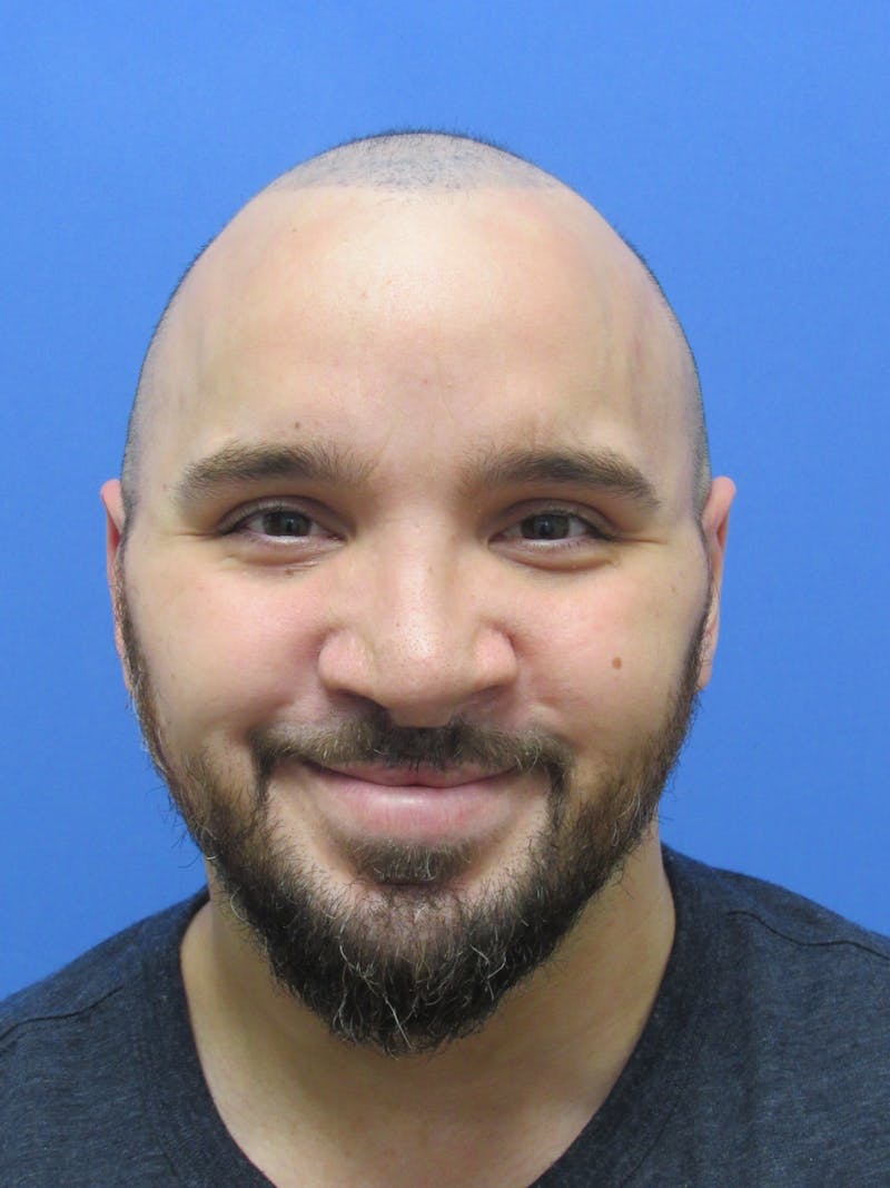 Facial Hair Transplant Before & After Gallery - Patient 188959 - Image 4