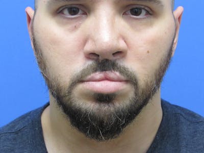 Facial Hair Transplant Before & After Gallery - Patient 188959 - Image 2