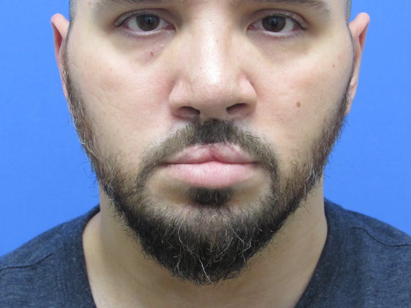 Facial Hair Transplant Before & After Gallery - Patient 188959 - Image 2